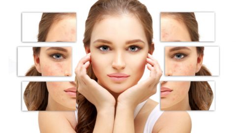 افضل 3 طرق علاج تصبغات الوجه بالرياض الناتج عن المحاليل