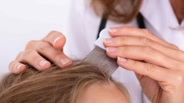 افضل 9 طرق ناجحة في علاج القمل في الشعر بالرياض