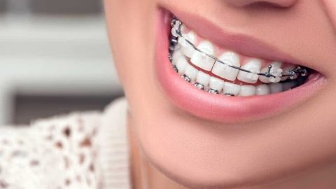 افضل 5 عيادات لتركيب تقويم اسنان في الرياض